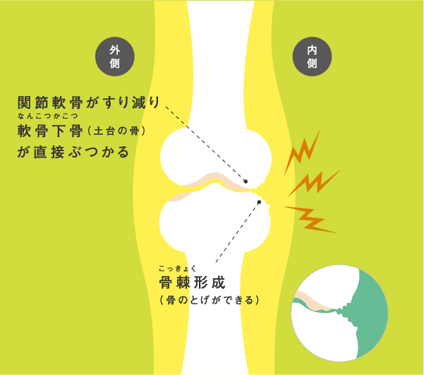 関節軟骨がすり減り軟骨下骨（土台の骨）が直接ぶつかる 骨棘形成（骨のとげができる）