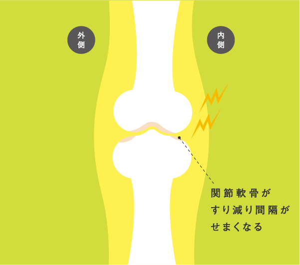 関節軟骨がすり減り間隔がせまくなる